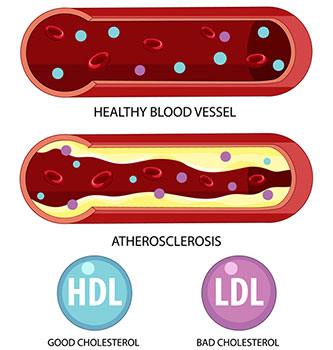 Cholesterol